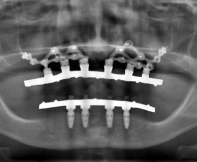 Subperiostal İmplant, Subperiostal Implant,